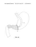 SATIATION DEVICES AND METHODS diagram and image