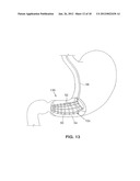 SATIATION DEVICES AND METHODS diagram and image