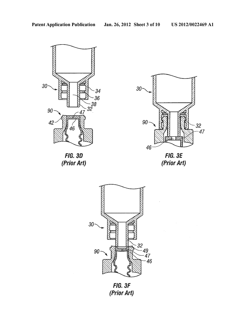 NEEDLELESS VALVE INFECTION PREVENTION AND PRE-OPENING DEVICE - diagram, schematic, and image 04