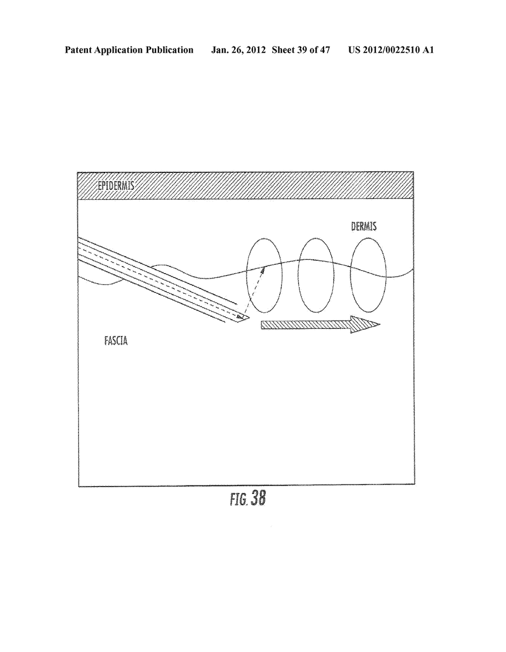 THERMAL SURGERY SAFETY APPARATUS AND METHOD - diagram, schematic, and image 40