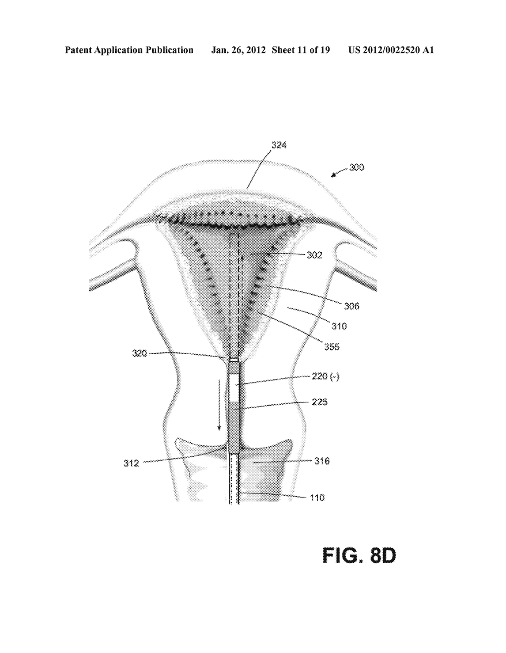 METHODS AND SYSTEMS FOR ENDOMETRIAL ABLATION - diagram, schematic, and image 12