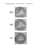 BONE CEMENT SYSTEM FOR BONE AUGMENTATION diagram and image