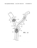 OCCLUSION DEVICE AND METHOD OF USE diagram and image