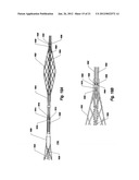 OCCLUSION DEVICE AND METHOD OF USE diagram and image