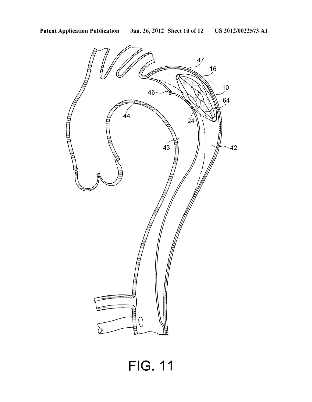 FALSE LUMEN OCCLUDER - diagram, schematic, and image 11