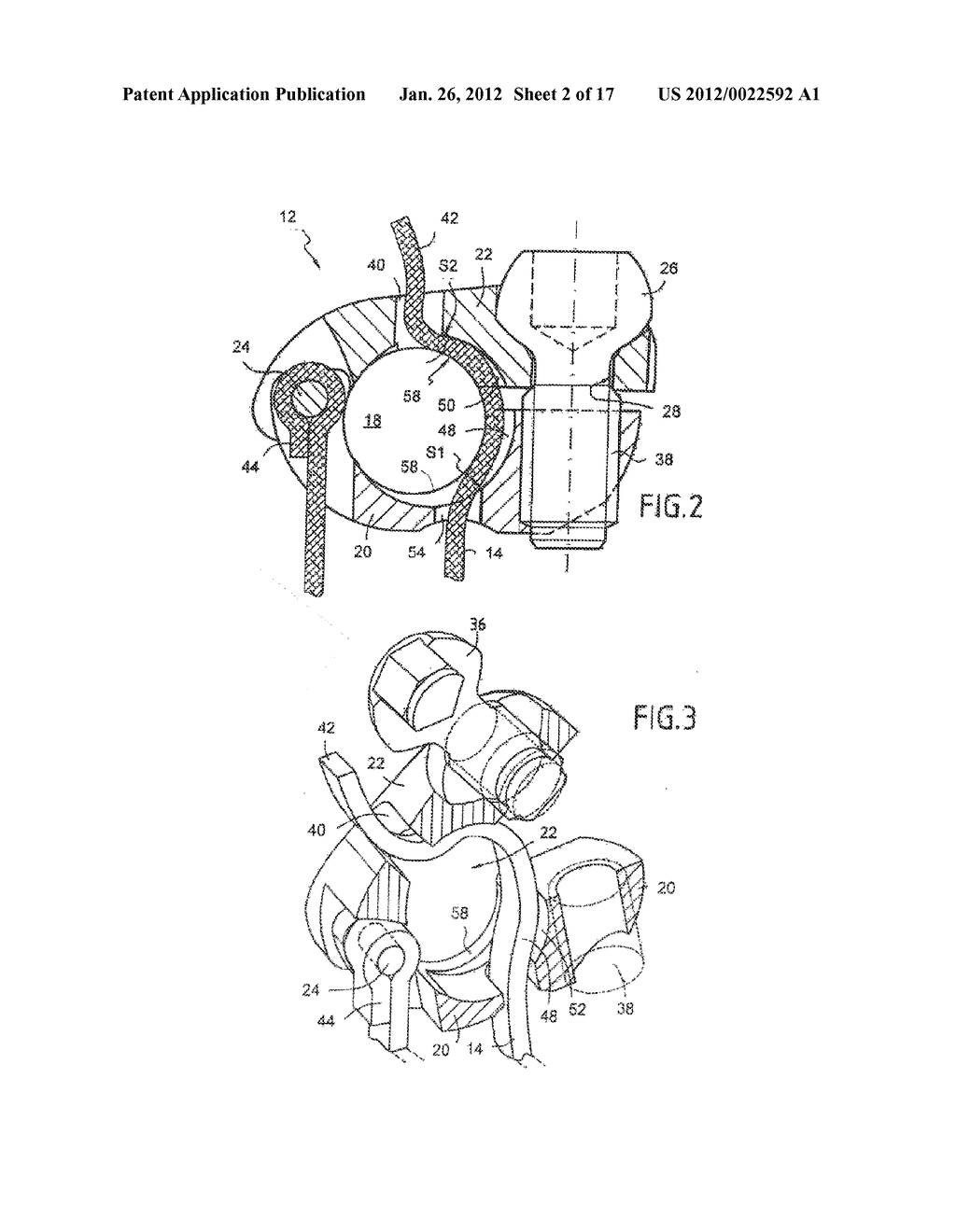 BONE FIXING SYSTEM AND METHOD OF USE - diagram, schematic, and image 03