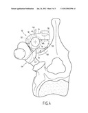 VERTEBRAL FIXING SYSTEM diagram and image