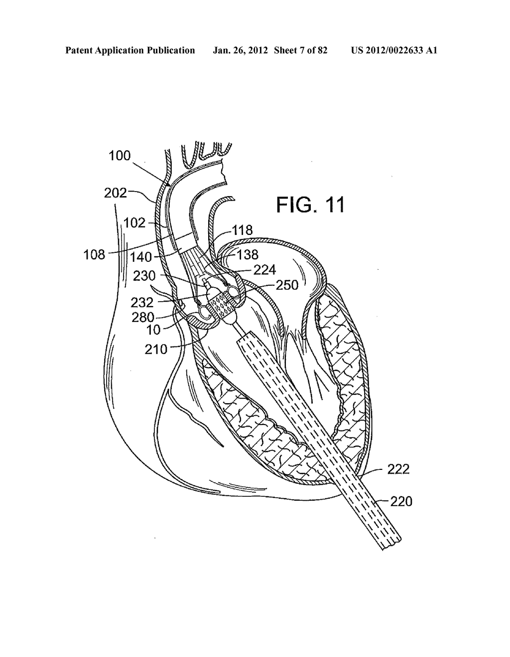 RETAINING MECHANISMS FOR PROSTHETIC VALVES - diagram, schematic, and image 08