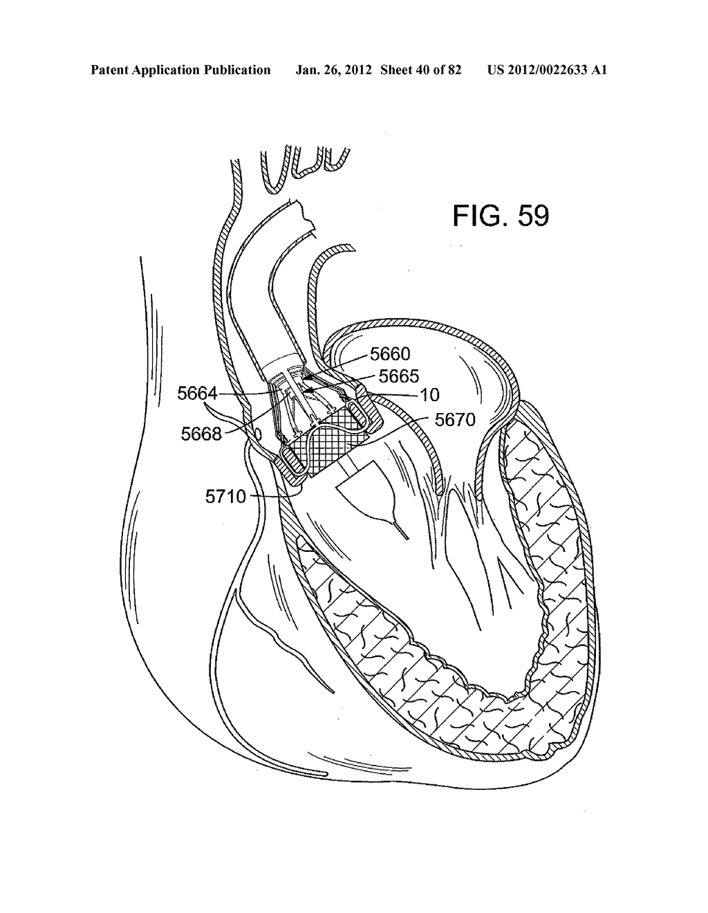 RETAINING MECHANISMS FOR PROSTHETIC VALVES - diagram, schematic, and image 41