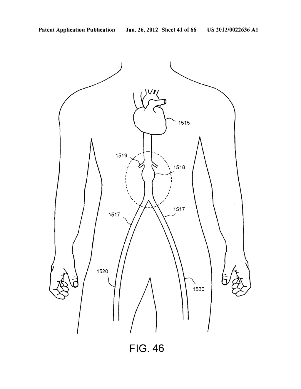 METHOD OF DELIVERING ADVANCED ENDOVASCULAR GRAFT - diagram, schematic, and image 42