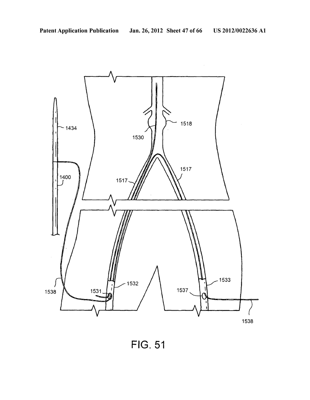 METHOD OF DELIVERING ADVANCED ENDOVASCULAR GRAFT - diagram, schematic, and image 48