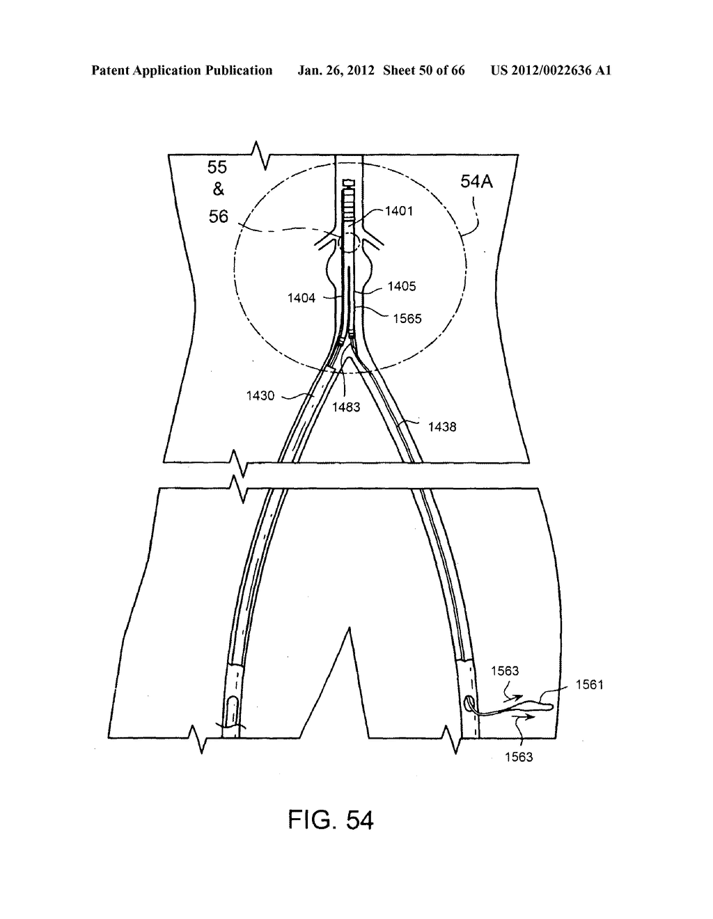 METHOD OF DELIVERING ADVANCED ENDOVASCULAR GRAFT - diagram, schematic, and image 51