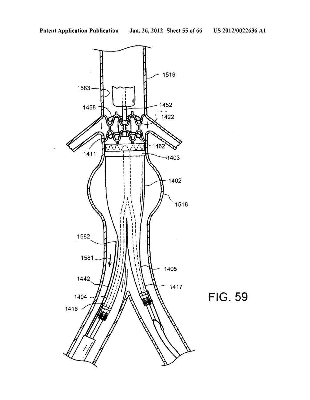 METHOD OF DELIVERING ADVANCED ENDOVASCULAR GRAFT - diagram, schematic, and image 56