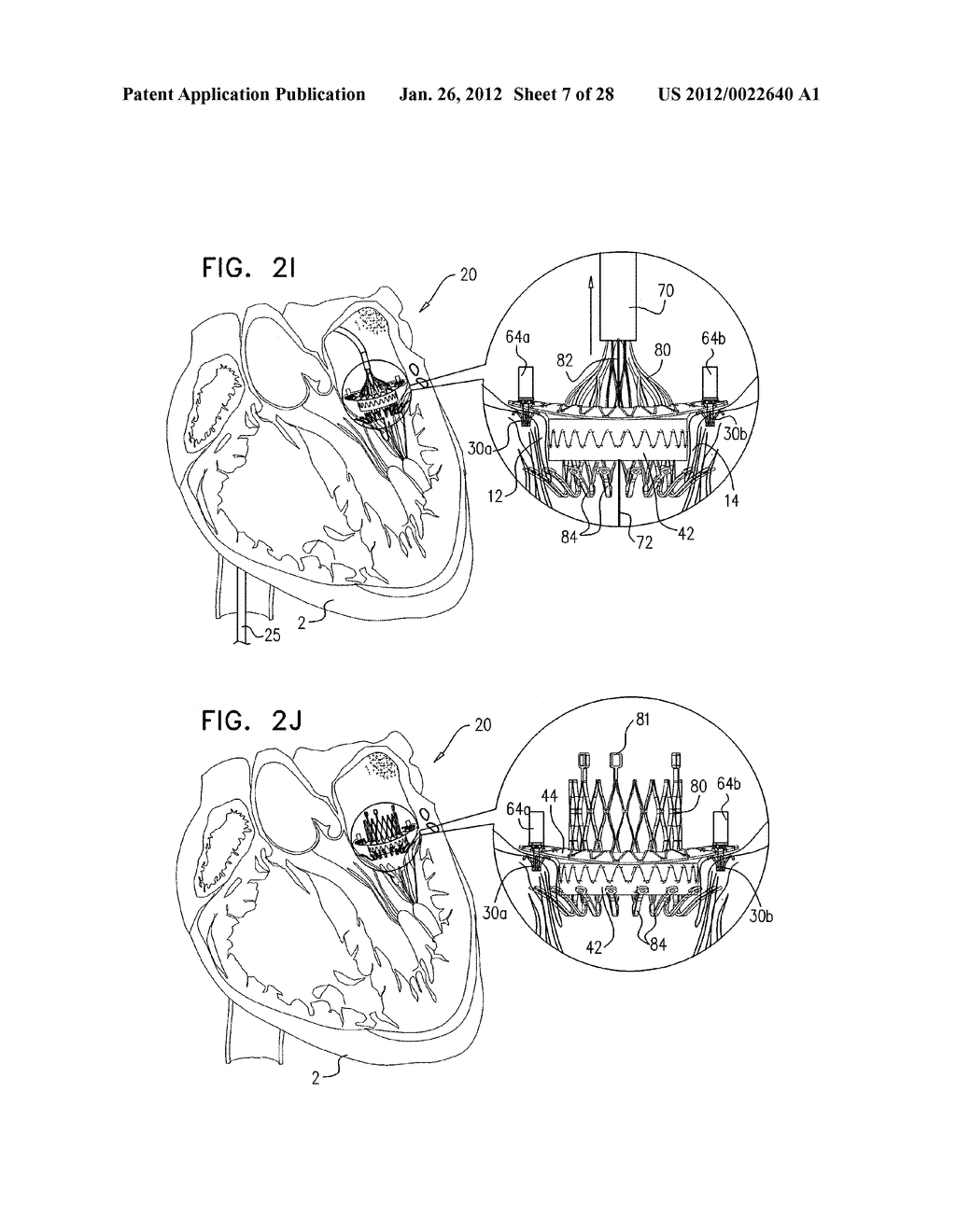 TECHNIQUES FOR PERCUTANEOUS MITRAL VALVE REPLACEMENT AND SEALING - diagram, schematic, and image 08