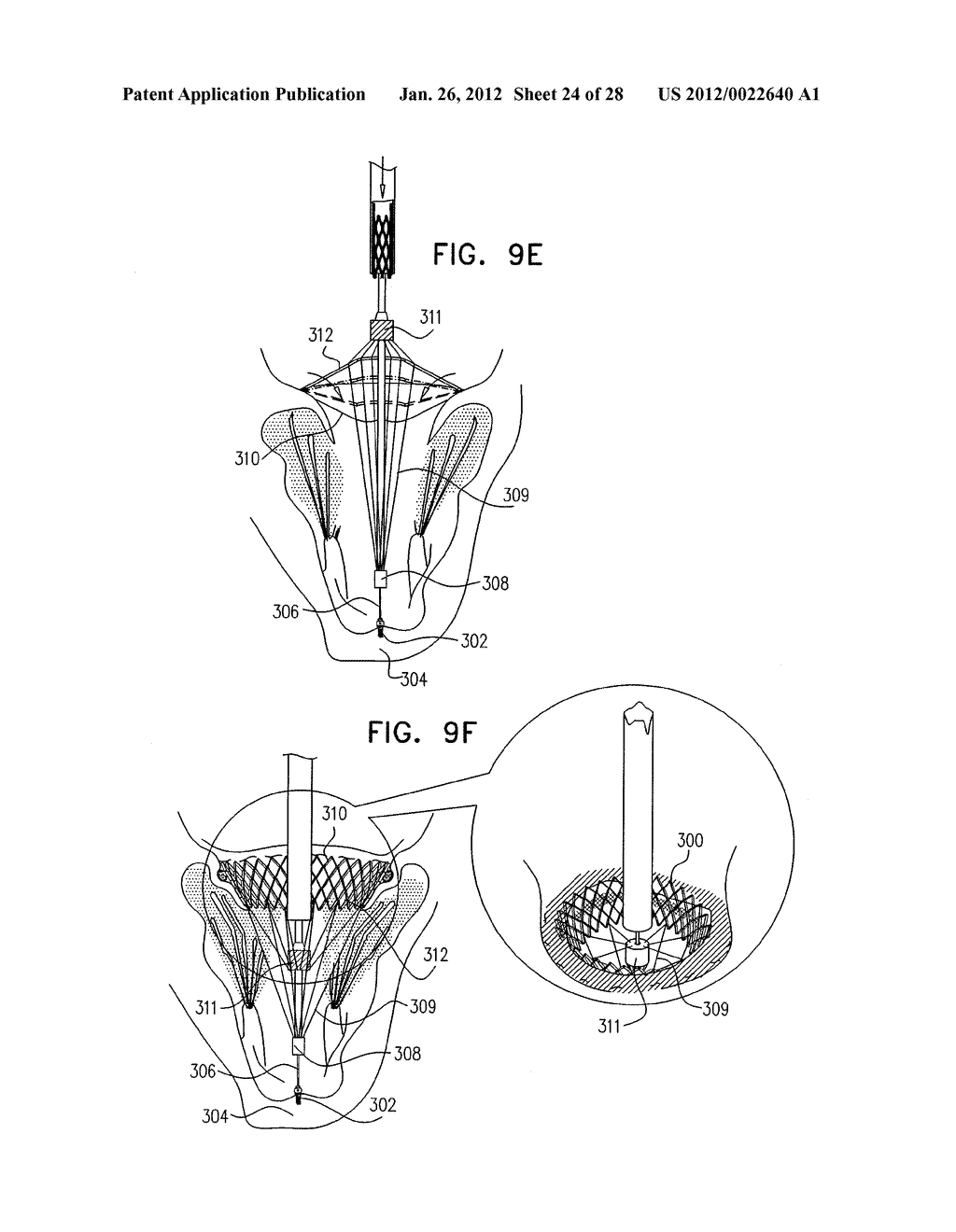 TECHNIQUES FOR PERCUTANEOUS MITRAL VALVE REPLACEMENT AND SEALING - diagram, schematic, and image 25