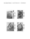 PROSTHETIC DEVICE AND METHOD OF USING IN BREAST AUGMENTATION AND/OR BREAST     RECONSTRUCTION diagram and image