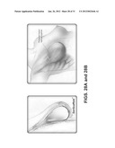 PROSTHETIC DEVICE AND METHOD OF USING IN BREAST AUGMENTATION AND/OR BREAST     RECONSTRUCTION diagram and image