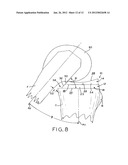 ASYMMETRIC TIBIAL COMPONENTS FOR A KNEE PROSTHESIS diagram and image