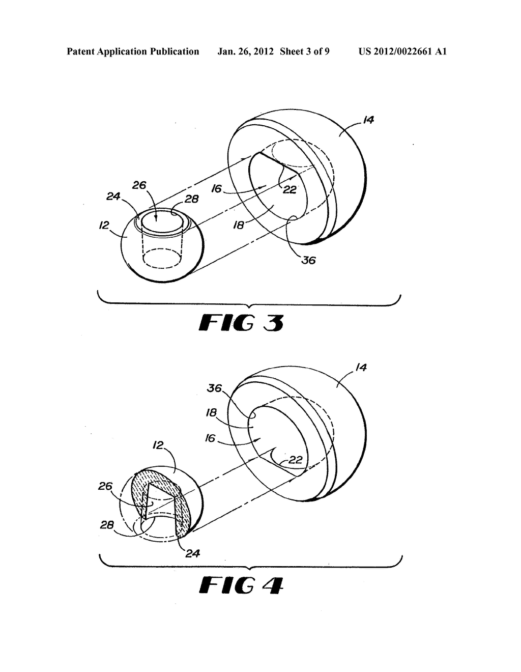 CONTAINMENT SYSTEM FOR CONSTRAINING A PROSTHETIC COMPONENT - diagram, schematic, and image 04