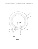 BRAIDED LOOP UTILIZING BIFURCATION TECHNOLOGY diagram and image