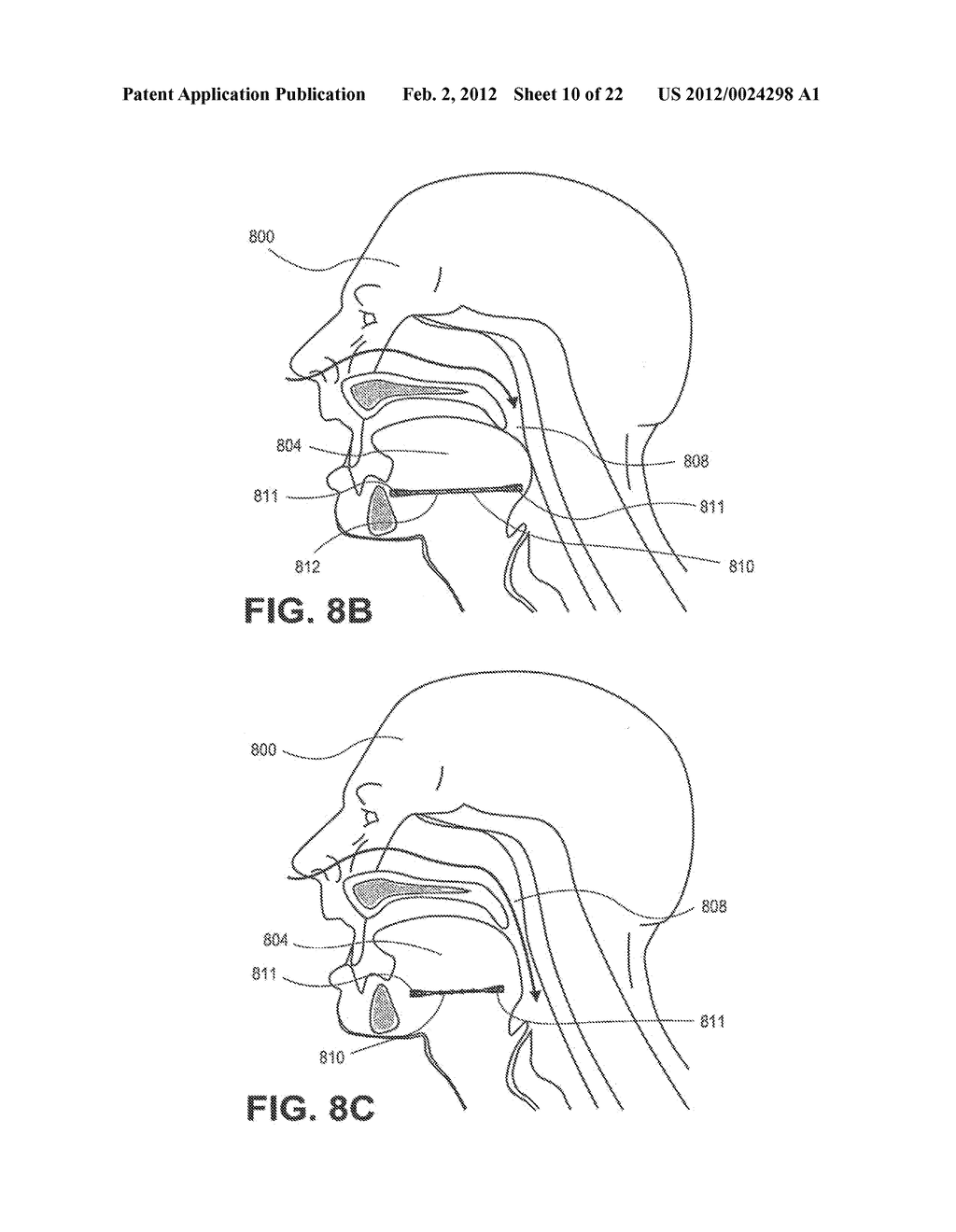 PARTIALLY ERODABLE SYSTEMS FOR TREATMENT OF OBSTRUCTIVE SLEEP APNEA - diagram, schematic, and image 11