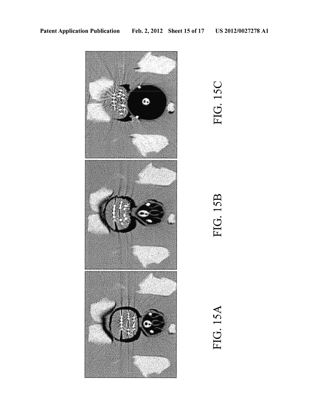 METHODS, SYSTEMS, AND COMPUTER READABLE MEDIA FOR MAPPING REGIONS IN A     MODEL OF AN OBJECT COMPRISING AN ANATOMICAL STRUCTURE FROM ONE IMAGE DATA     SET TO IMAGES USED IN A DIAGNOSTIC OR THERAPEUTIC INTERVENTION - diagram, schematic, and image 16