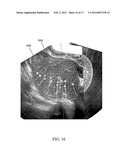 METHODS, SYSTEMS, AND COMPUTER READABLE MEDIA FOR MAPPING REGIONS IN A     MODEL OF AN OBJECT COMPRISING AN ANATOMICAL STRUCTURE FROM ONE IMAGE DATA     SET TO IMAGES USED IN A DIAGNOSTIC OR THERAPEUTIC INTERVENTION diagram and image