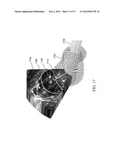 METHODS, SYSTEMS, AND COMPUTER READABLE MEDIA FOR MAPPING REGIONS IN A     MODEL OF AN OBJECT COMPRISING AN ANATOMICAL STRUCTURE FROM ONE IMAGE DATA     SET TO IMAGES USED IN A DIAGNOSTIC OR THERAPEUTIC INTERVENTION diagram and image