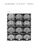 Methods for Distributing High Levels of Therapeutic Agent Throughout the     Cortex to Treat Neurological Disorders diagram and image