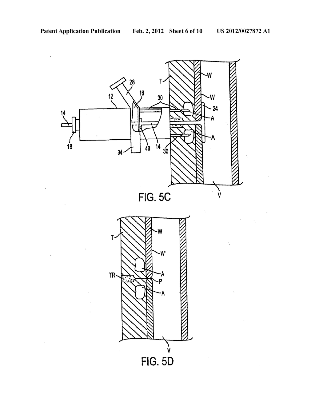 APPARATUS FOR SEALING A PUNCTURE BY CAUSING A REDUCTION IN THE     CIRCUMFERENCE OF THE PUNCTURE - diagram, schematic, and image 07