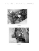 CORRECTION OF ALVEOLAR CLEFT WITH CALCIUM-BASED BONE GRAFT MATERIALS diagram and image