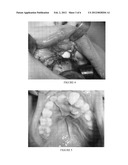 CORRECTION OF ALVEOLAR CLEFT WITH CALCIUM-BASED BONE GRAFT MATERIALS diagram and image