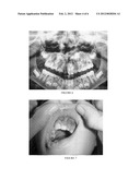 CORRECTION OF ALVEOLAR CLEFT WITH CALCIUM-BASED BONE GRAFT MATERIALS diagram and image