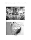 CORRECTION OF ALVEOLAR CLEFT WITH CALCIUM-BASED BONE GRAFT MATERIALS diagram and image