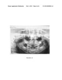 CORRECTION OF ALVEOLAR CLEFT WITH CALCIUM-BASED BONE GRAFT MATERIALS diagram and image