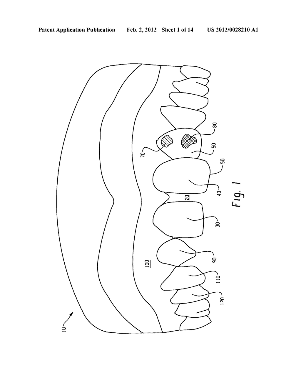 STENTS AND METHOD FOR DENTAL RESTORATION USING SAME - diagram, schematic, and image 02