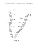 STENTS AND METHOD FOR DENTAL RESTORATION USING SAME diagram and image