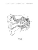 Electromagnetic Bone Conduction Hearing Device diagram and image