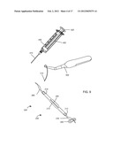 BODILY IMPLANTS AND METHODS OF ADJUSTING THE SAME diagram and image