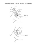 BODILY IMPLANTS AND METHODS OF ADJUSTING THE SAME diagram and image