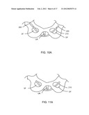 BODILY IMPLANTS AND METHODS OF ADJUSTING THE SAME diagram and image