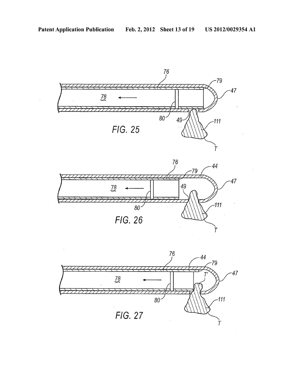 TISSUE REMOVAL DEVICE WITH ADJUSTABLE DELIVERY SLEEVE FOR NEUROSURGICAL     AND SPINAL SURGERY APPLICATIONS - diagram, schematic, and image 14