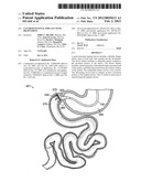 GASTROINTESTINAL IMPLANT WITH DRAWSTRING diagram and image