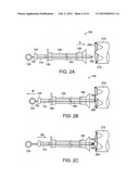 GASTROINTESTINAL IMPLANT WITH DRAWSTRING diagram and image