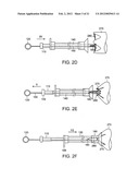 GASTROINTESTINAL IMPLANT WITH DRAWSTRING diagram and image