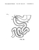 GASTROINTESTINAL IMPLANT WITH DRAWSTRING diagram and image