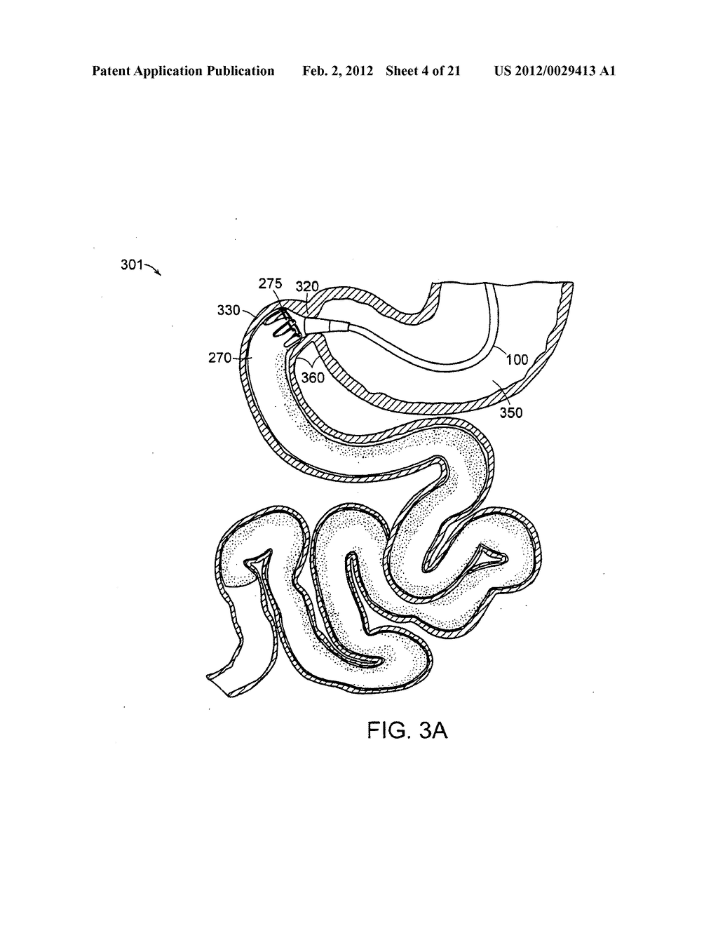 GASTROINTESTINAL IMPLANT WITH DRAWSTRING - diagram, schematic, and image 05