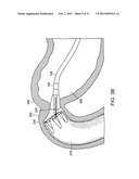 GASTROINTESTINAL IMPLANT WITH DRAWSTRING diagram and image