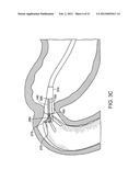 GASTROINTESTINAL IMPLANT WITH DRAWSTRING diagram and image
