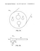 GASTROINTESTINAL IMPLANT WITH DRAWSTRING diagram and image